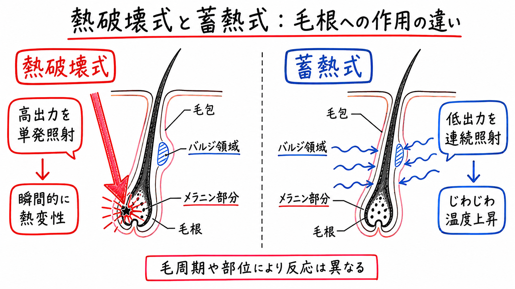 熱破壊式と蓄熱式、毛根への作用の仕組みはどう異なるか