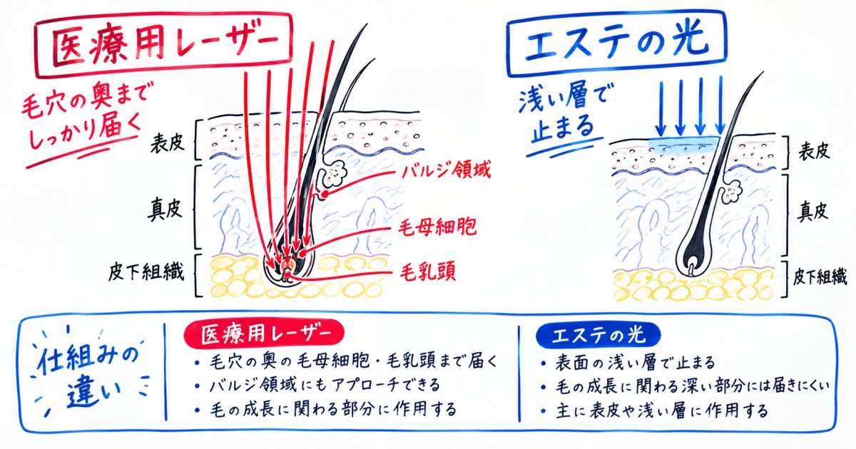 医療脱毛とサロン脱毛の仕組みの違い|照射出力と組織への作用