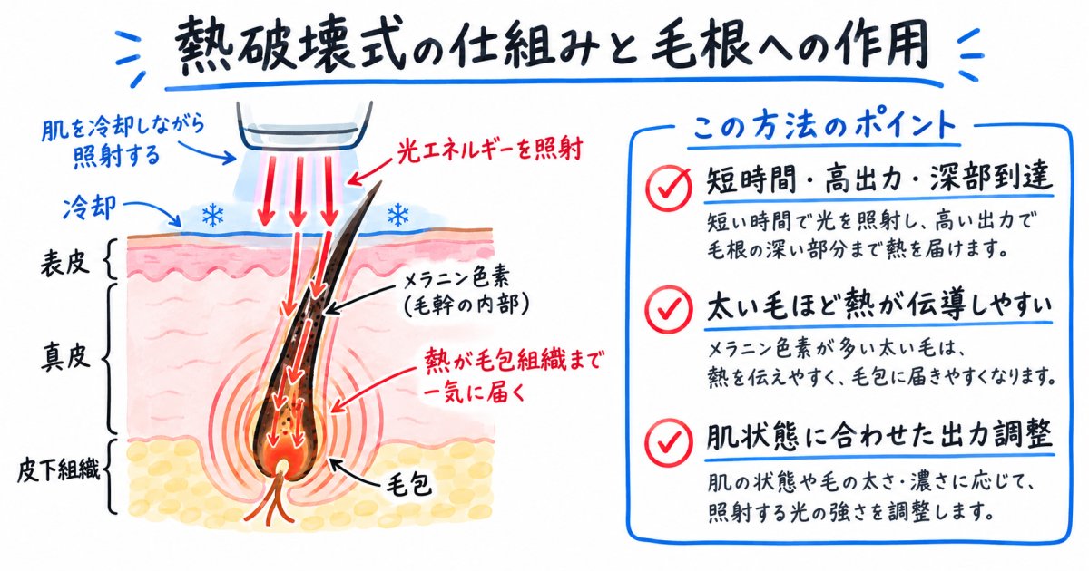 熱破壊式の照射方法と毛根組織への作用の仕組み