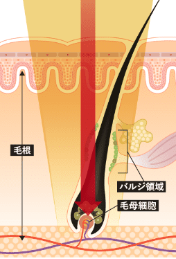 熱破壊式医療脱毛レーザー