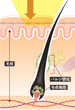 エステ脱毛機器