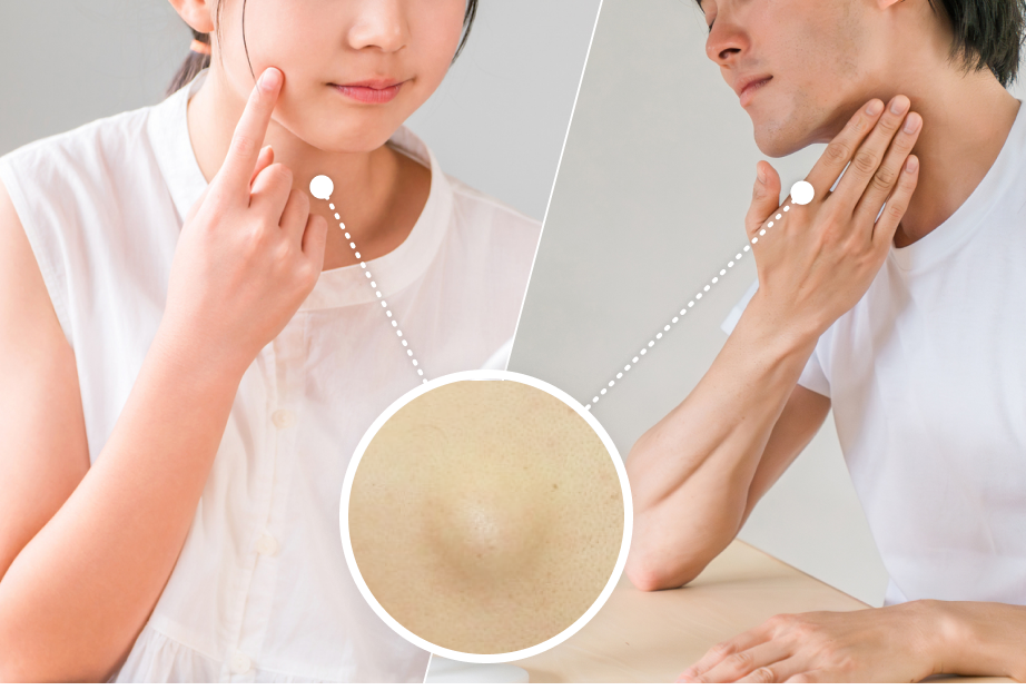 粉瘤を疑う様子