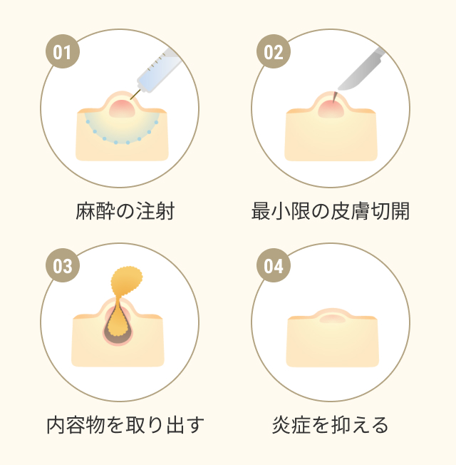 切開、排膿処置