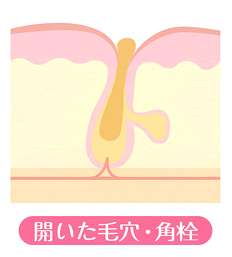 開いた毛穴・角栓