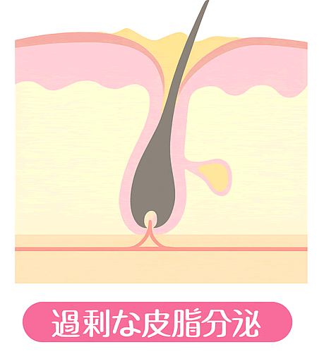 過剰な皮脂分泌