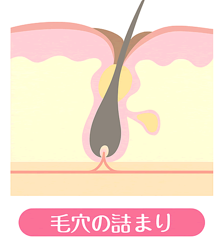 毛穴の詰まり