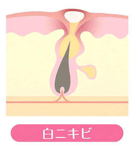 白ニキビ