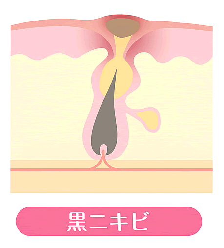 黒ニキビ