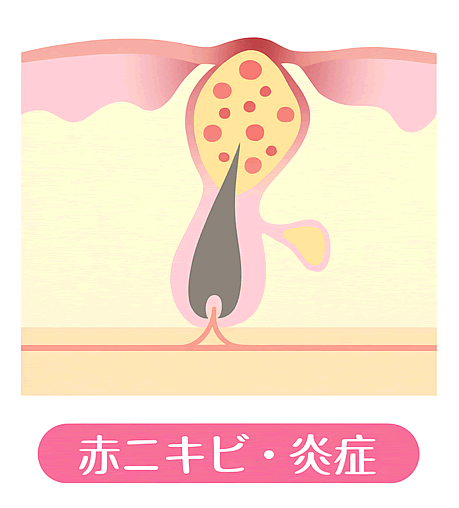 赤ニキビ・炎症