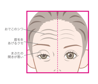 眼瞼下垂について 倉敷市の ながしま形成外科クリニック ながしま形成外科クリニック