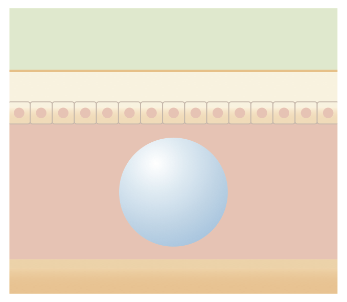 ヒアルロン酸注射図解3